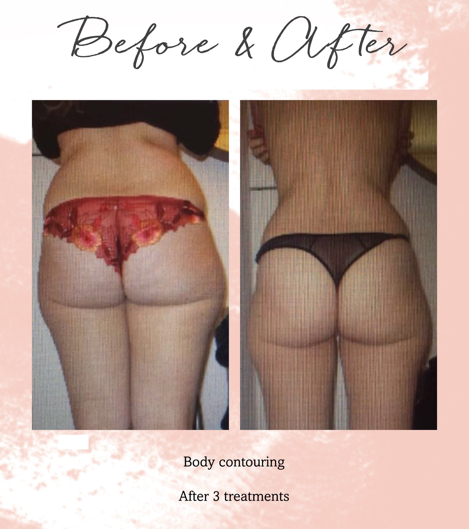 Body-contouring3