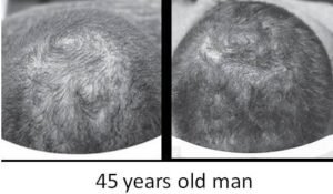 Hair-Loss3