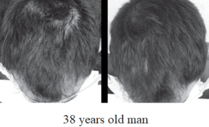 HairLoss