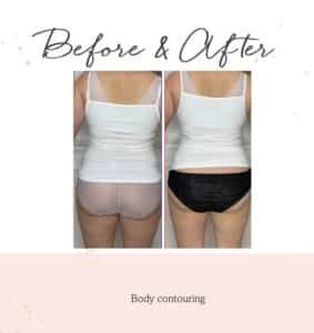 body-contouring1-1
