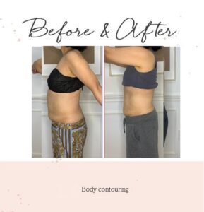 body-contouring2-1