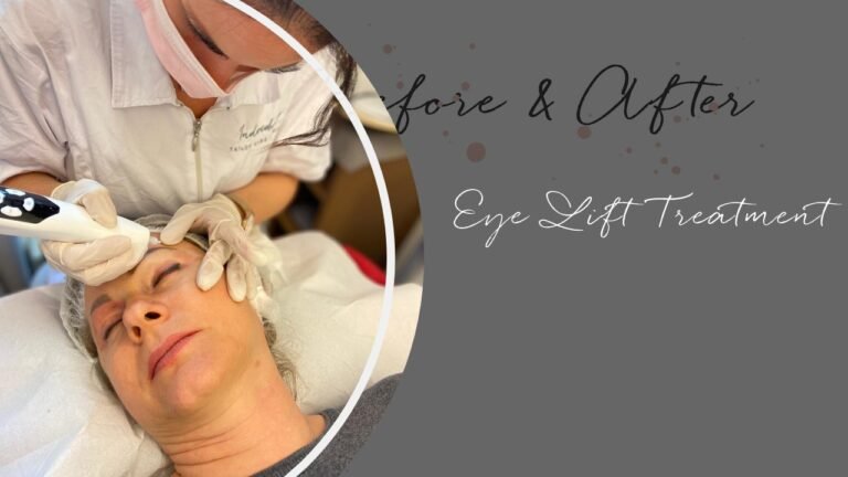 eye-lift1
